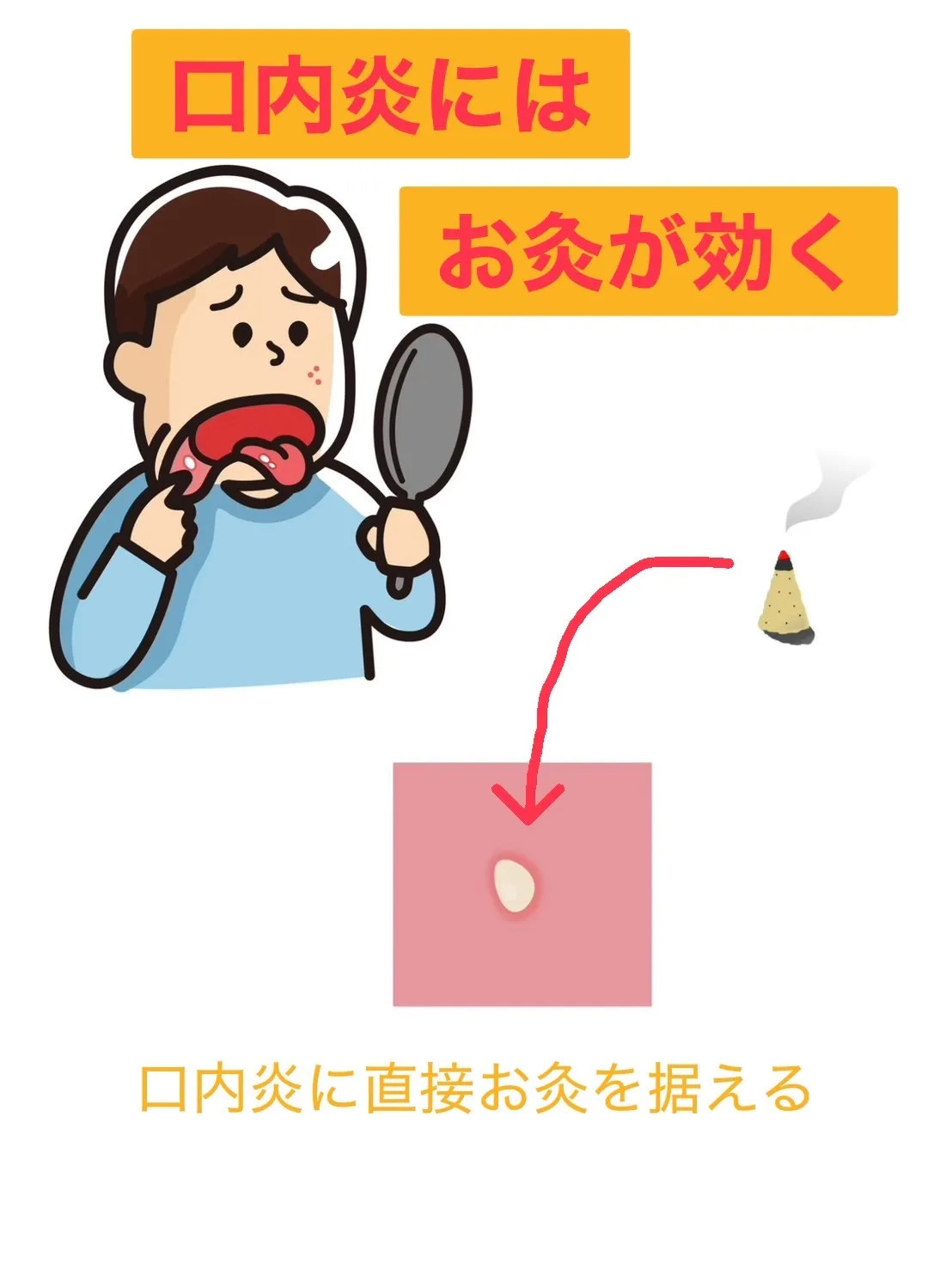 衝撃。口内炎にお灸が効く。